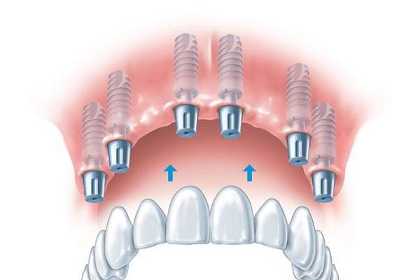 схема имплантации при полной потери зубов
