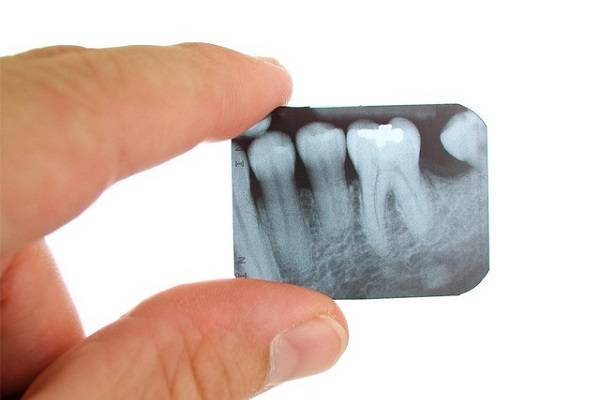 так выглядит зуб на рентгеновском снимке